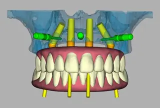 A digitally planned full-arch implant case at Signature Dental Group.