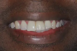 A finished case at Signature Dental Group, Delray Beach.