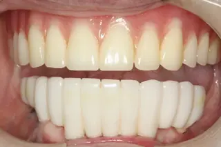 A finished case at Signature Dental Group, Delray Beach.